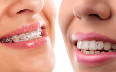 4 Myths About Invisalign® DeBunked
