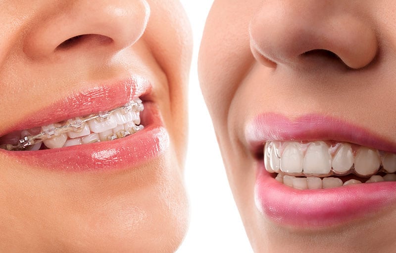 4 Myths About Invisalign® DeBunked