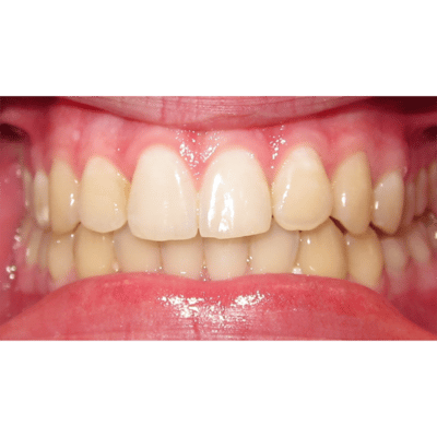 Teen smile after Invisalign