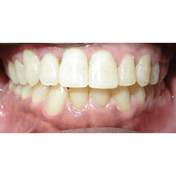 Mouth of patient after treatment