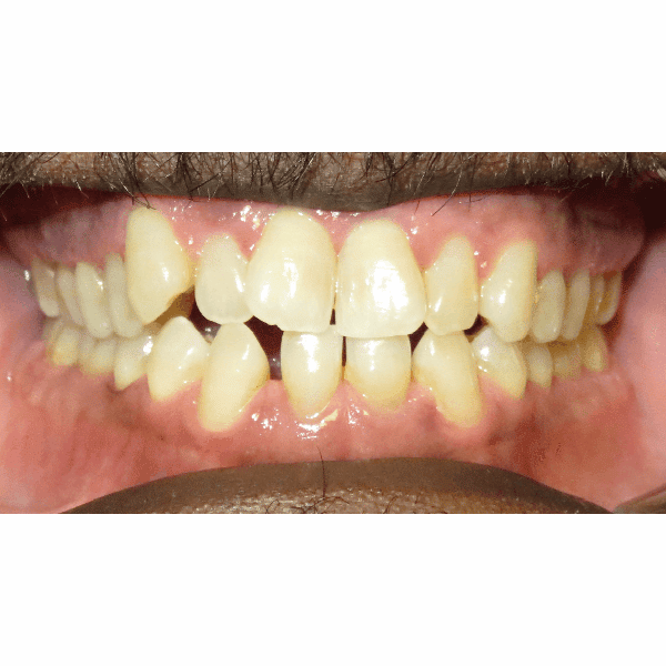 mouth of patient before treatment