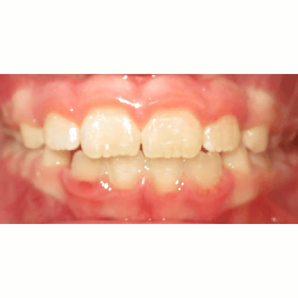 mouth after underbite treatment