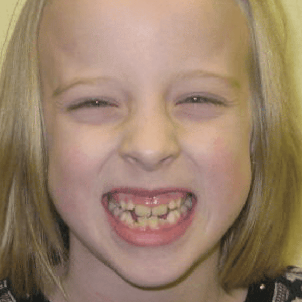 Child mouth before expander