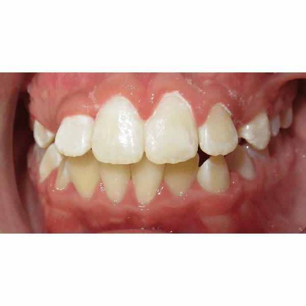 Patient Mouth After Phase I Treatment