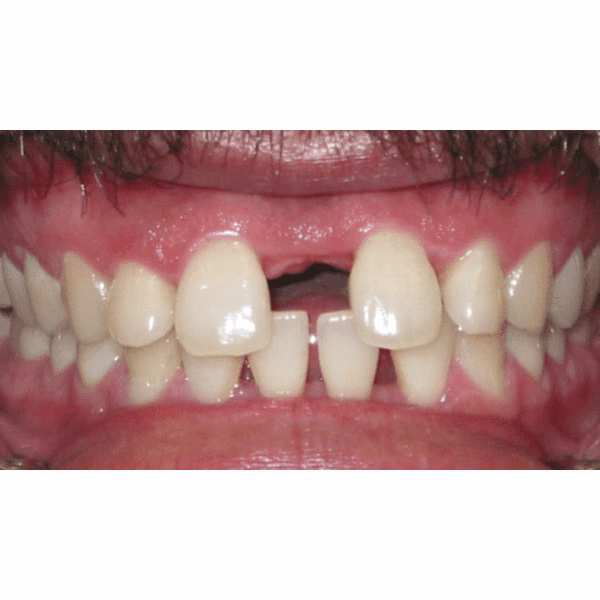 Patient gap in teeth before treatment
