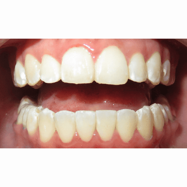 Patient mouth after treatment