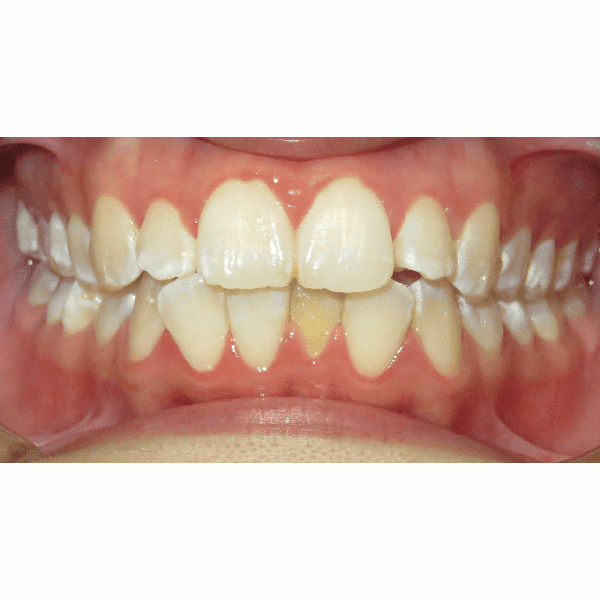 Patient mouth before treatment