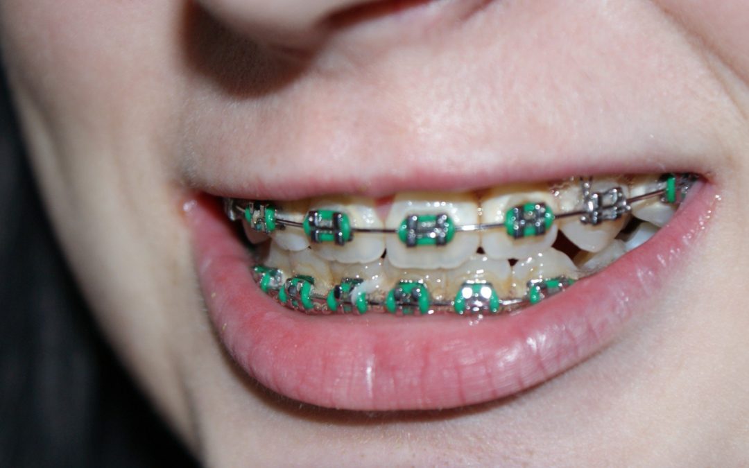 what age should you get braces