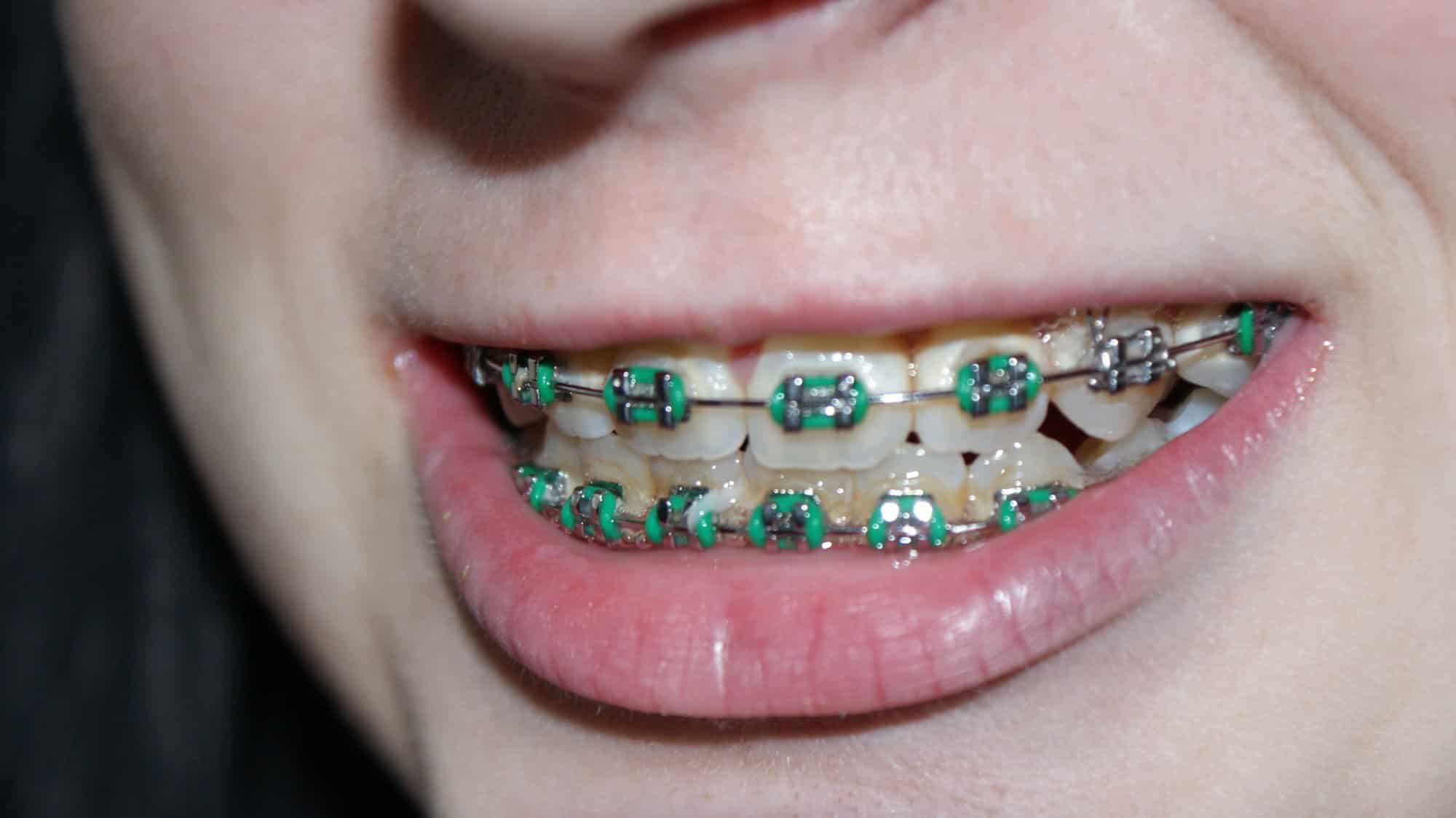 How Long Do You Have To Wear Braces For Crowded Teeth / Fix Crowded Teeth With Invisalign