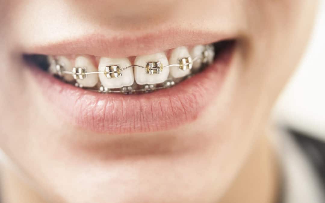 9 Reasons to Get Braces