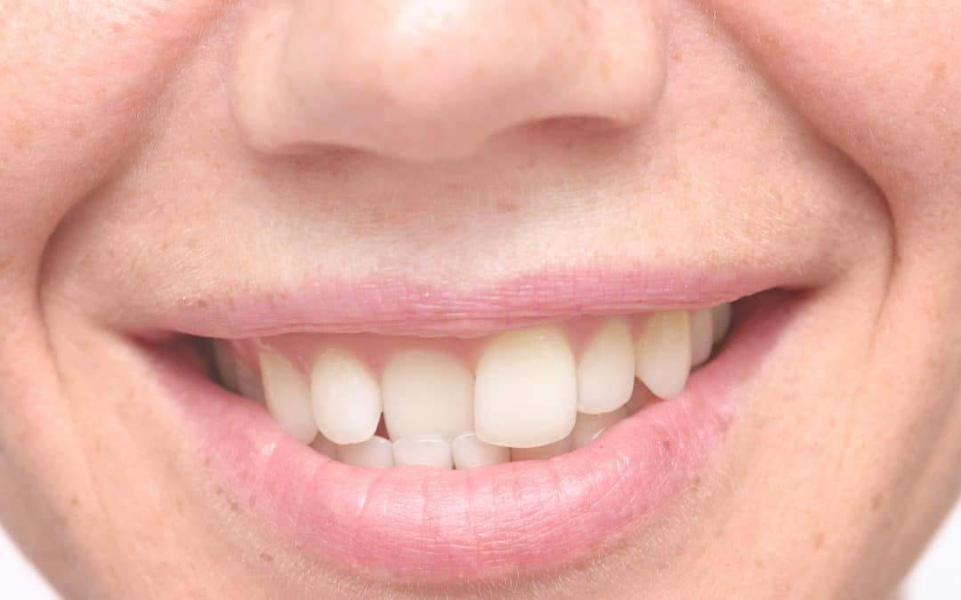 Braces for Kids: When Is the Right Time for Braces?
