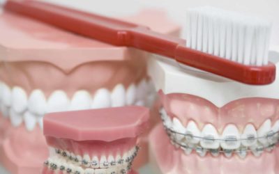 5 Reasons to Get Braces as an Adult