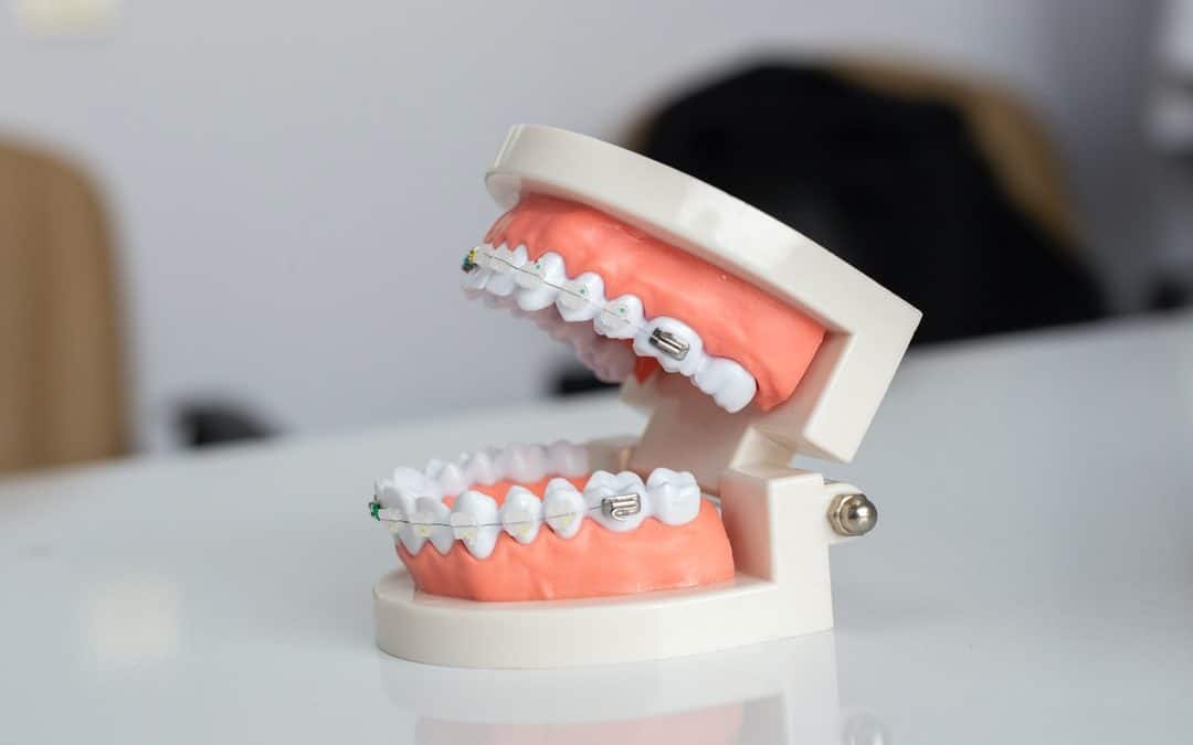 Broken Braces Bracket? What to Do, and How a Round Rock Orthodontist Can Help