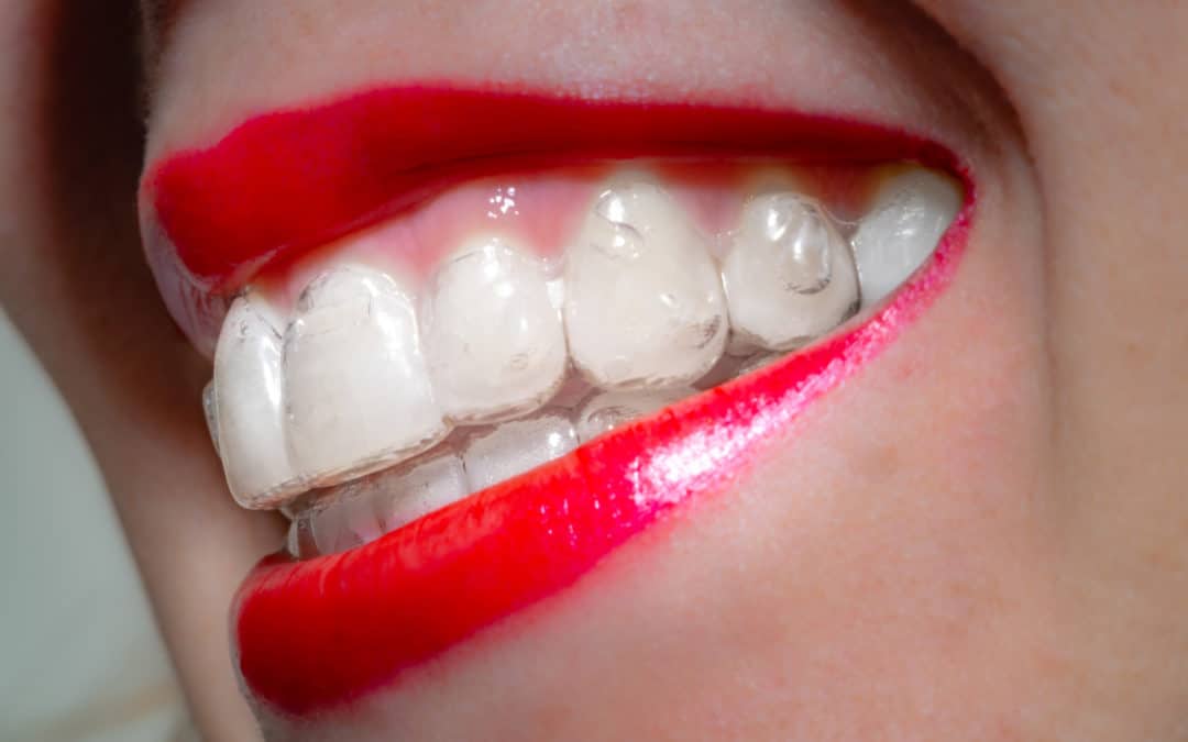 Invisalign for Adults: Everything You Need to Know