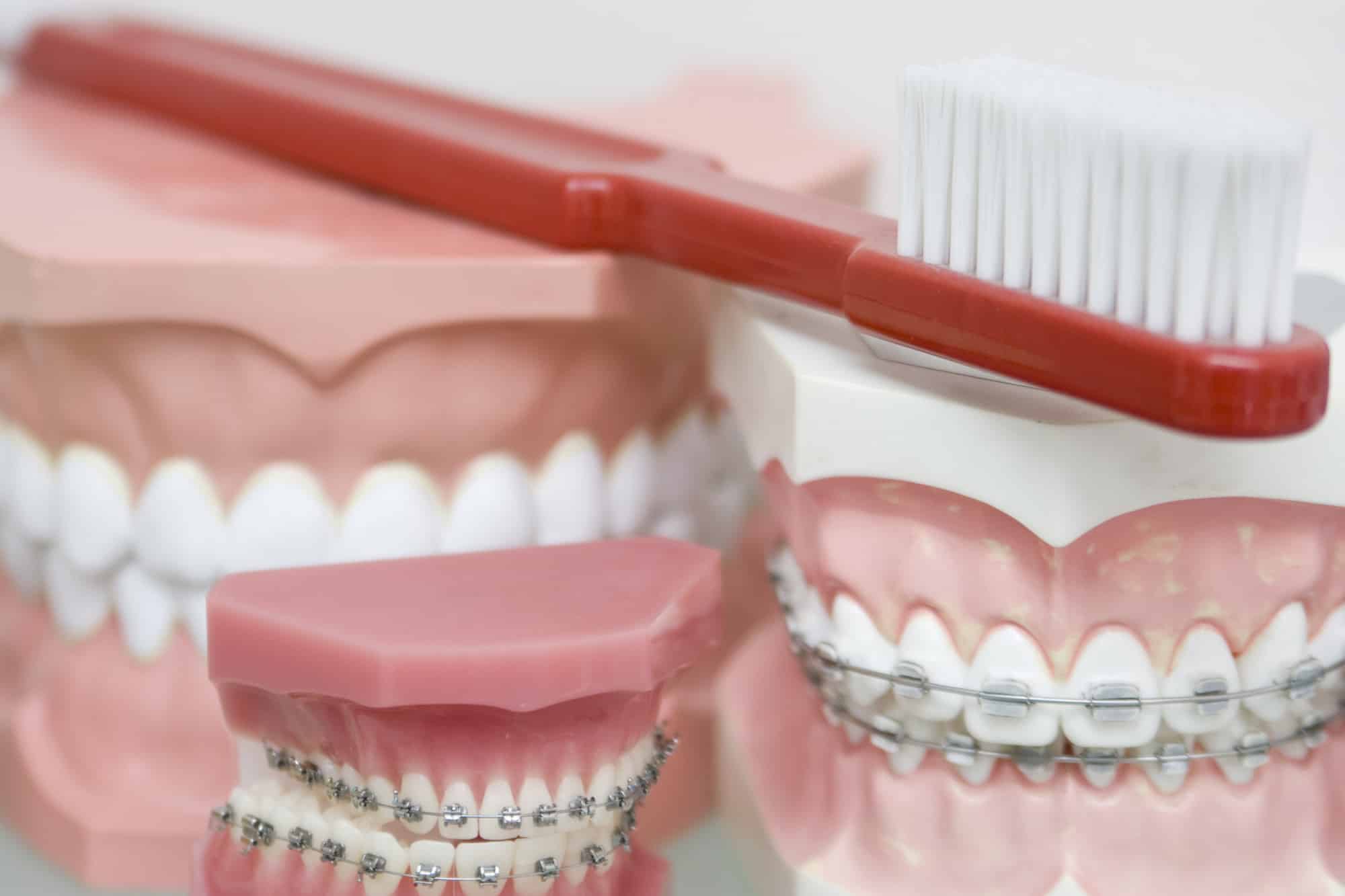 How Long Do You Have to Wear Braces? Sing Orthodontics