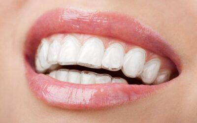 8 Must-Know Invisalign Tips