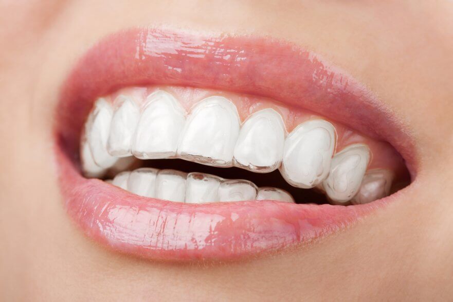 8 Must-Know Invisalign Tips