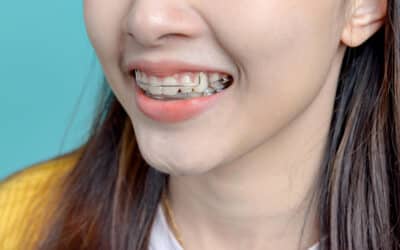 Lakeway Orthodontist: Exploring Retainer Options for Your Smile