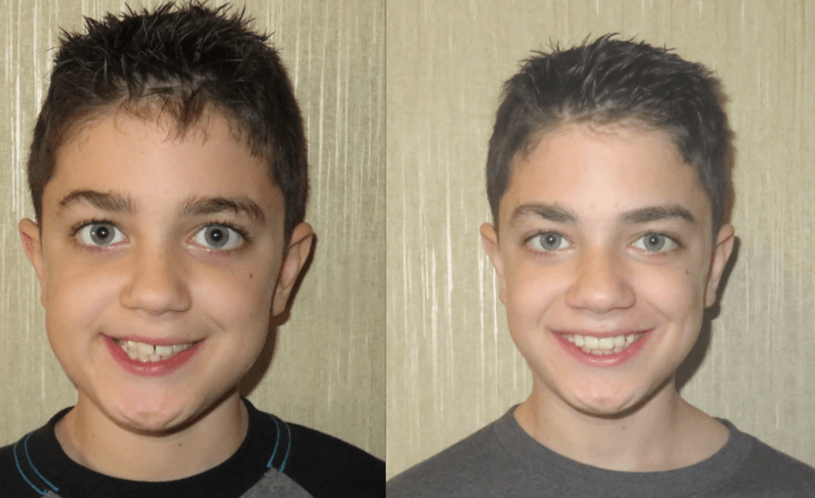 Early Orthodontic Care: Young patient showing facial symmetry restored after posterior crossbite correction.