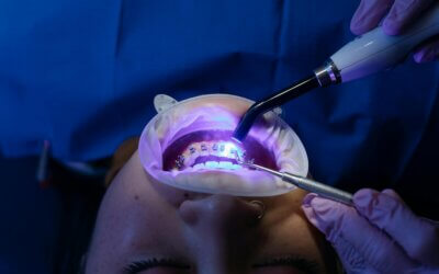 Top Orthodontist in Lakeway, TX: Achieve Your Perfect Smile